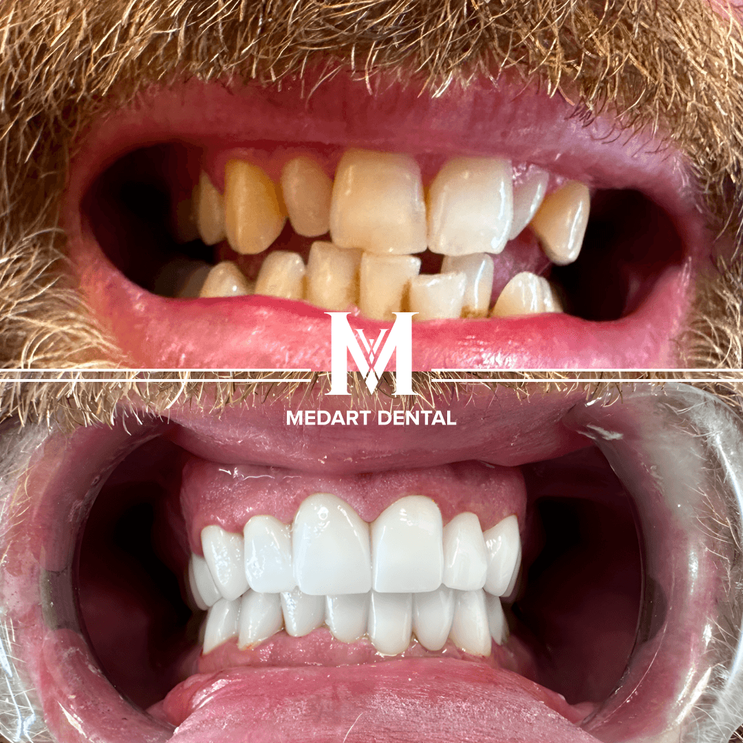 Before and After