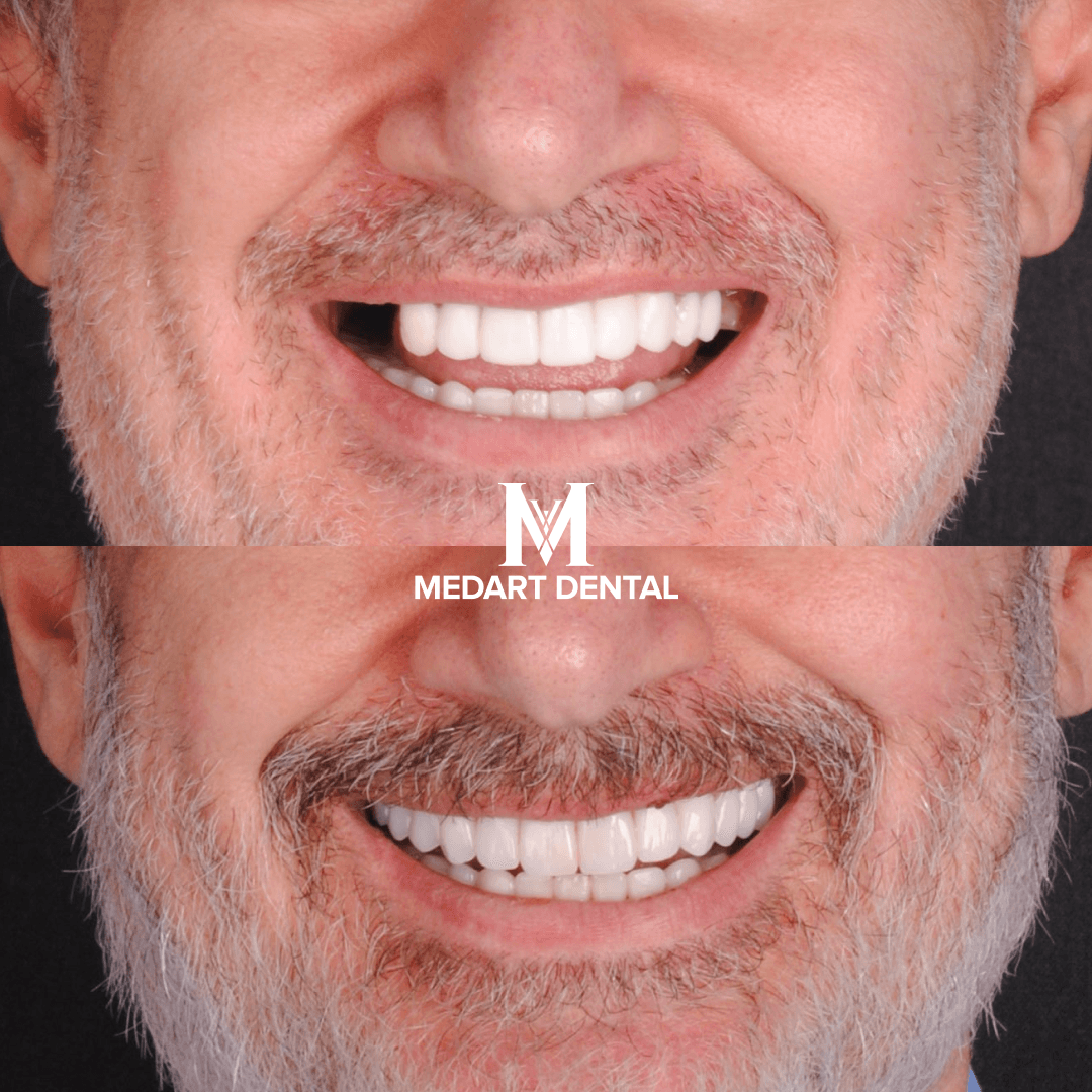 Before and After