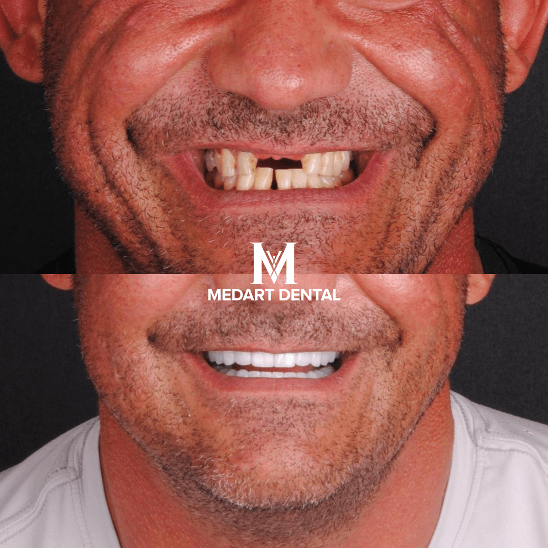 Before and After