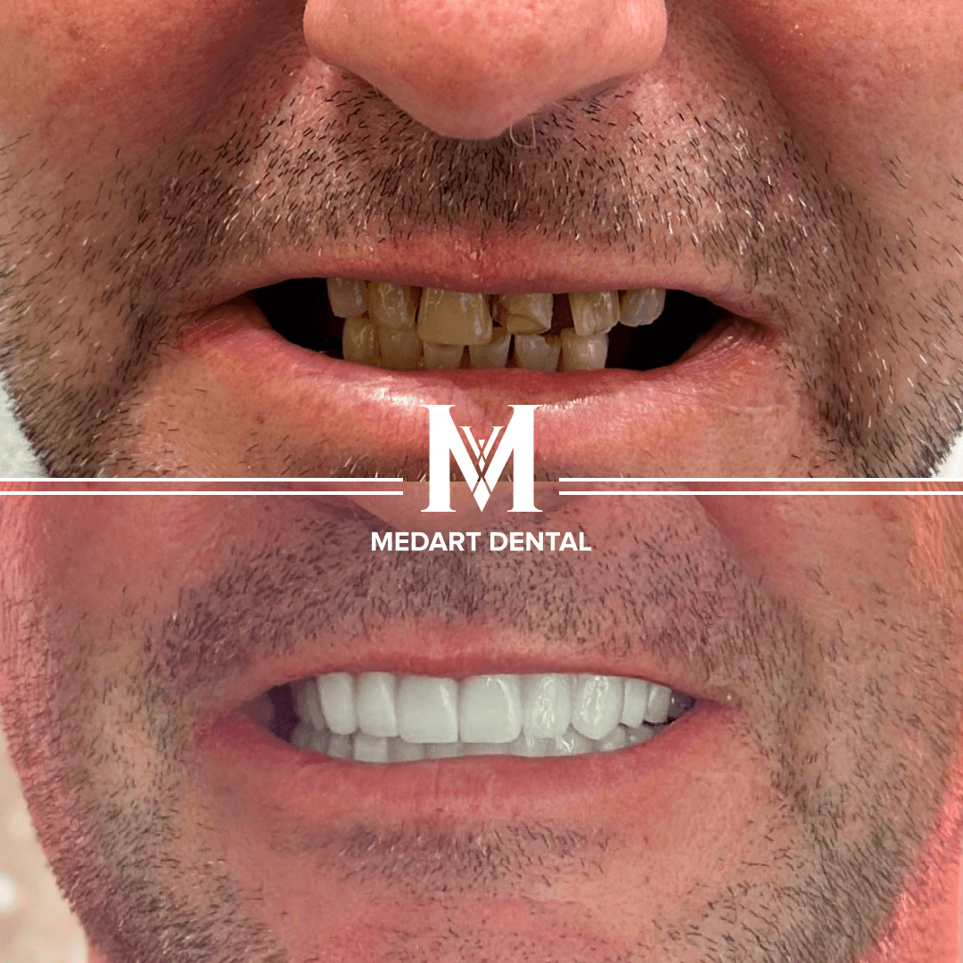 Before and After