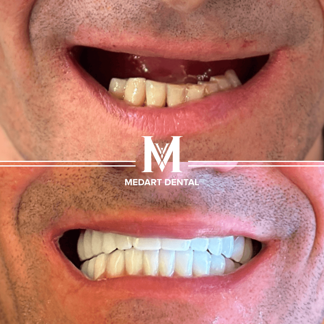 Before and After