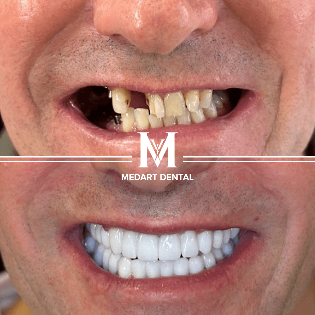 Before and After