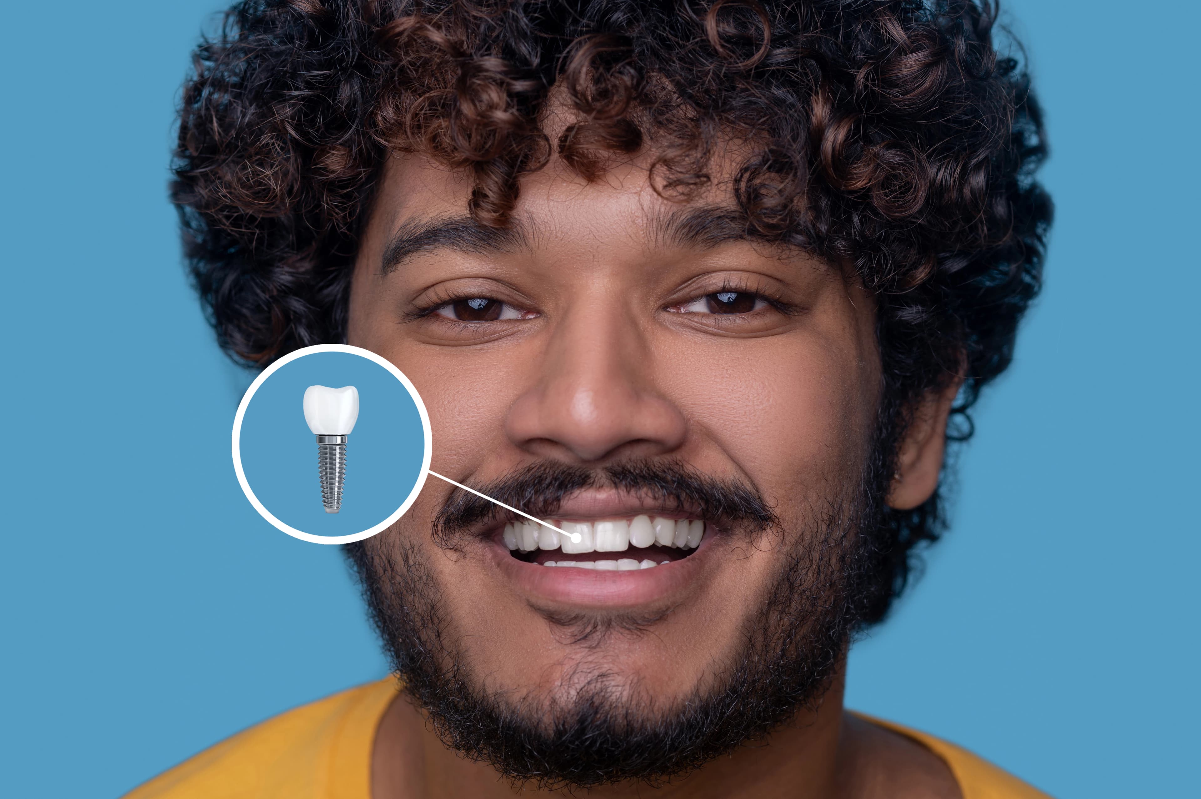 Dental Implants before and after